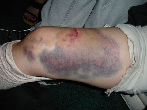 bruise.jpg